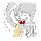 prostata ecografica kub
